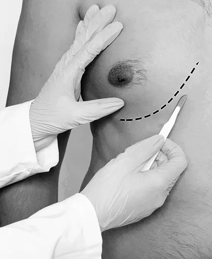 Treatment of breast enlargement in men